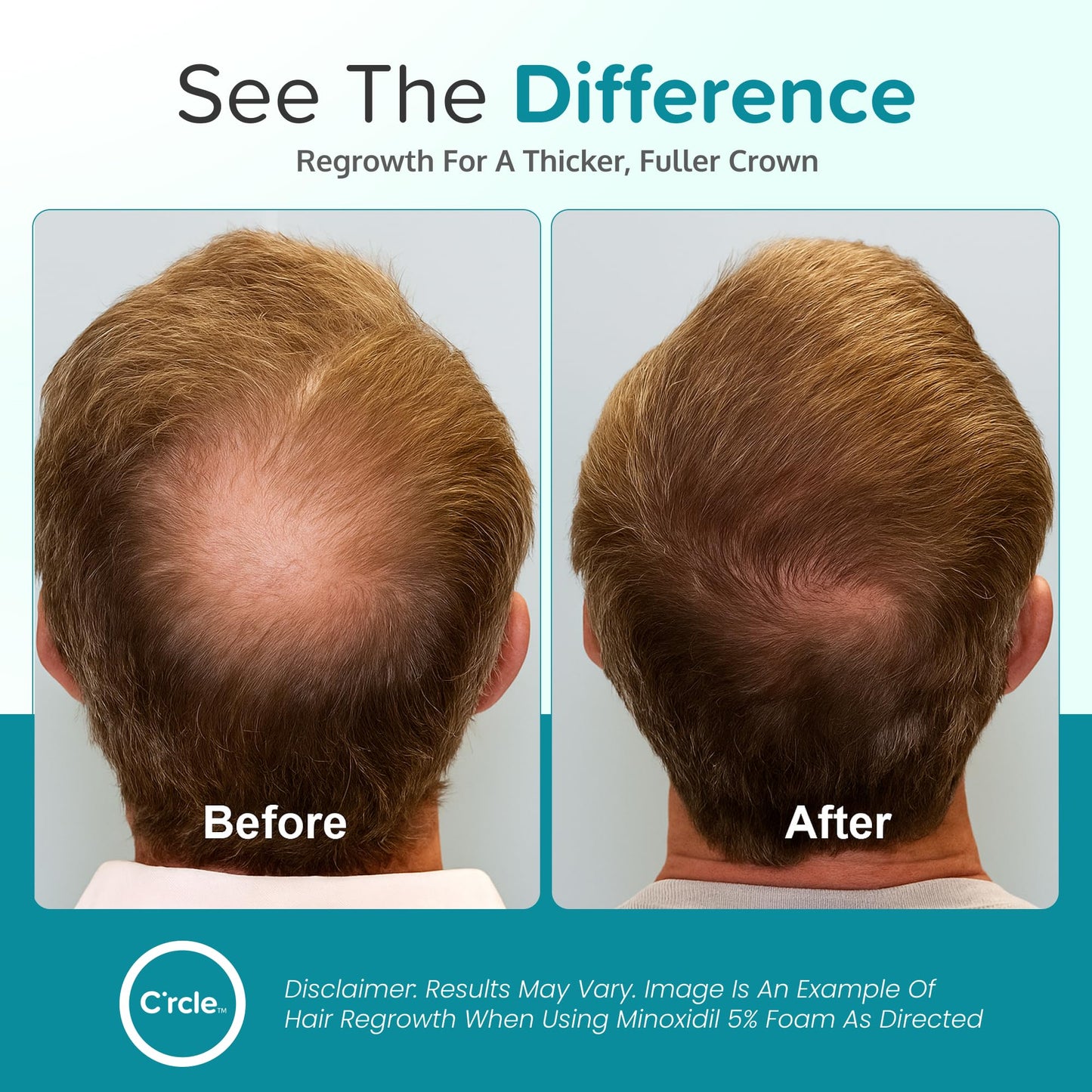 Minoxidil for Men Foam 5% - Unscented 3 Month Supply - Helps Restore Vertex Hair Loss & Thinning - 5% Minoxidil Foam For Men - Extra Strength Supports Hair Regrowth
