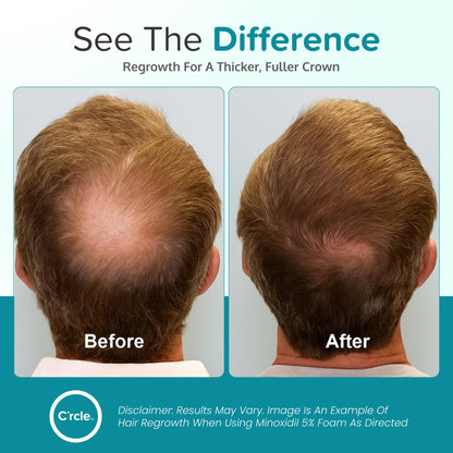 Minoxidil for Men Foam 5% - Unscented 3 Month Supply - Helps Restore Vertex Hair Loss & Thinning - 5% Minoxidil Foam For Men - Extra Strength Supports Hair Regrowth